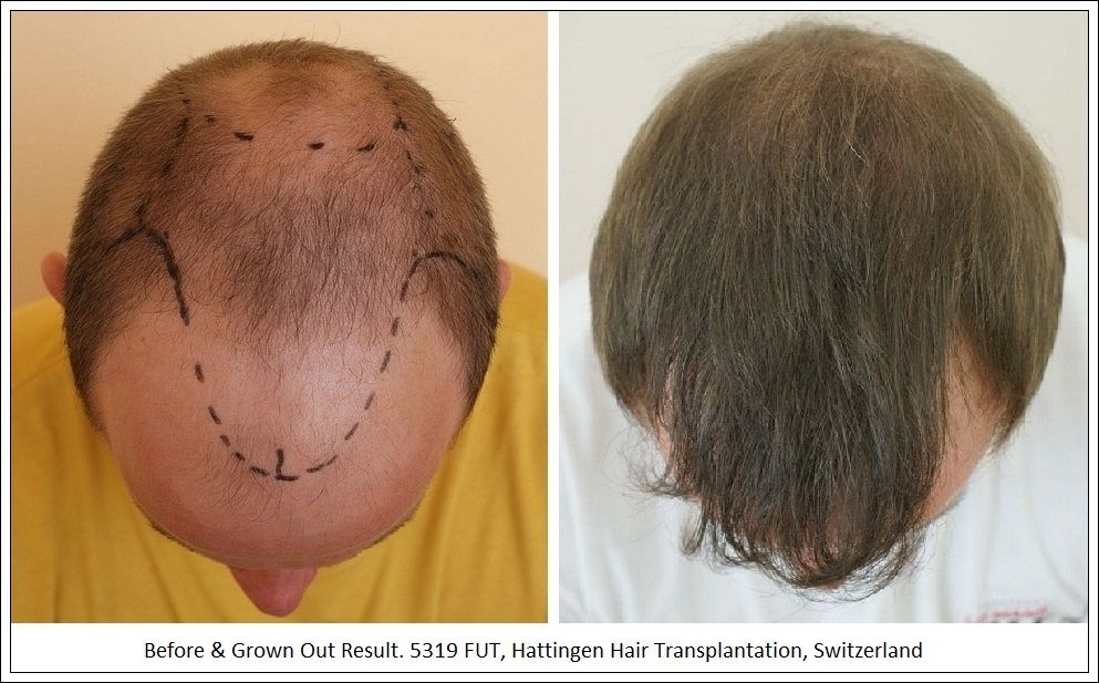 Hattingen Hair Hair Transplant 6.jpg