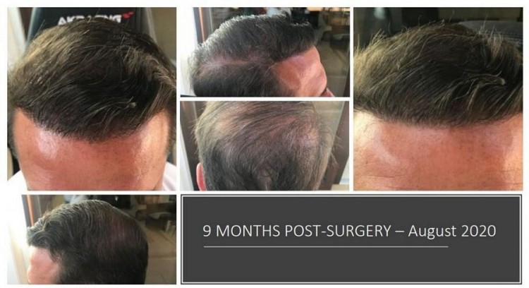 Hattingen Hair Hair Transplant 7.jpg