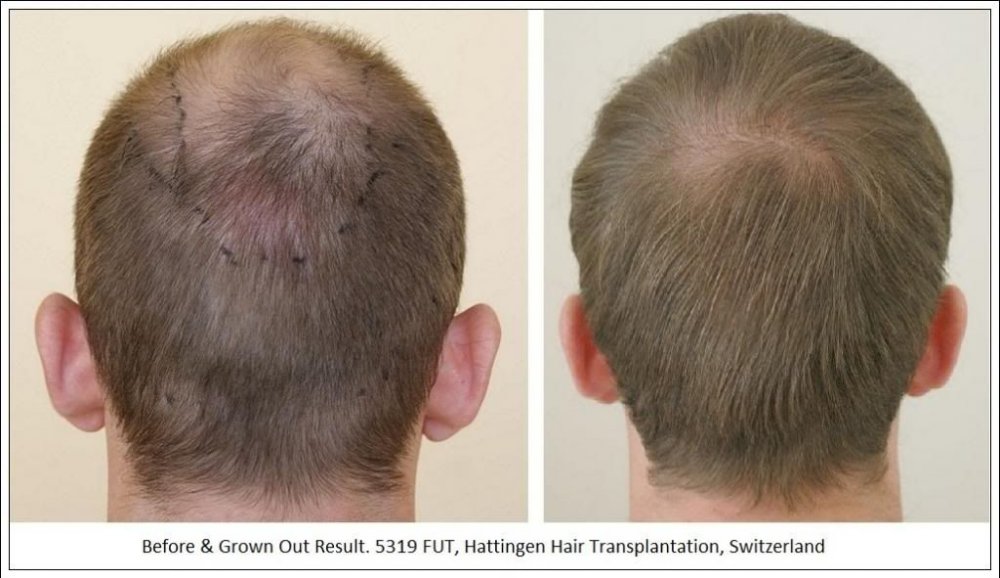 Hattingen Hair Hair Transplant 7.jpg
