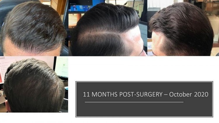 Hattingen Hair Hair Transplant 8.jpg