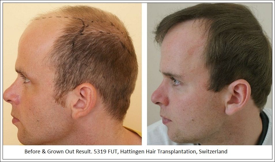 Hattingen Hair Hair Transplant 8.jpg