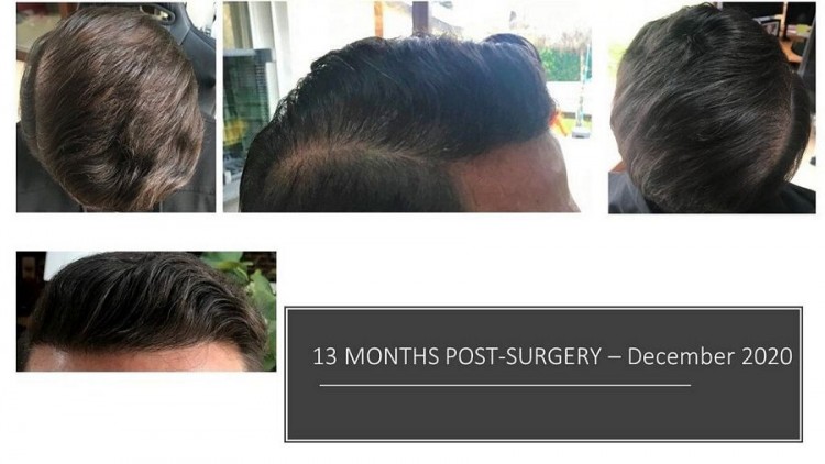 Hattingen Hair Hair Transplant 9.jpg