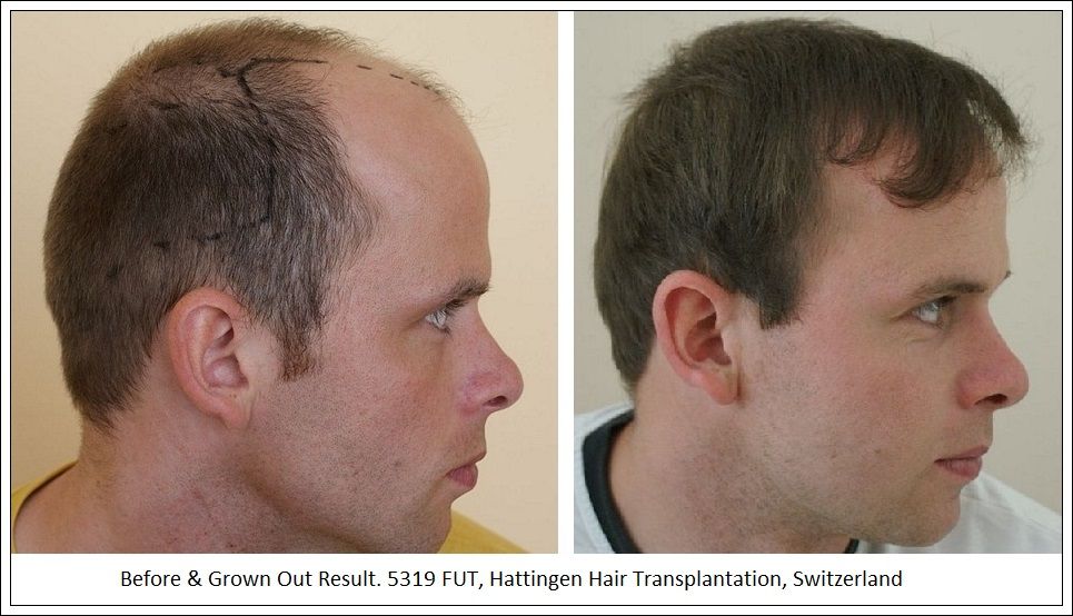 Hattingen Hair Hair Transplant 9.jpg