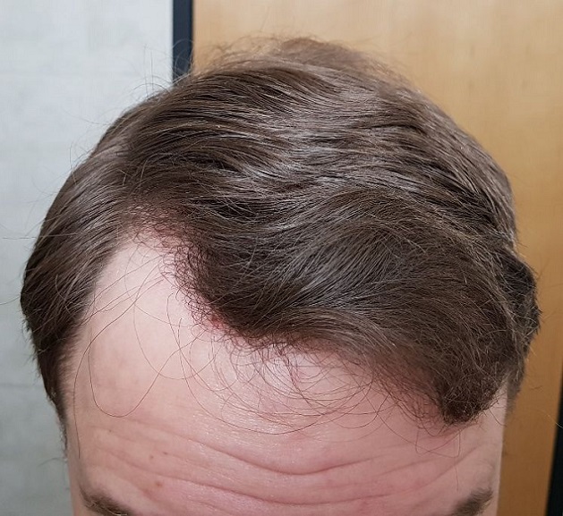Hattingen Hair Transplant 10.jpg