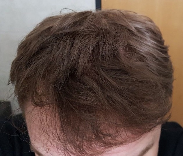 Hattingen Hair Transplant 11.jpg