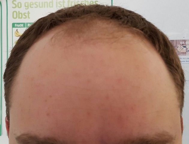 Hattingen Hair Transplant 2.jpg