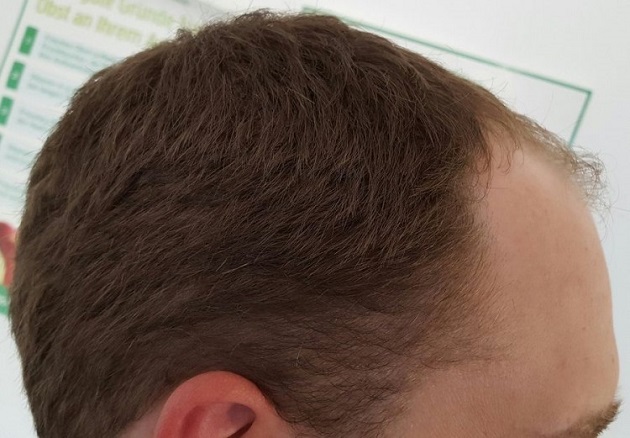 Hattingen Hair Transplant  3.jpg