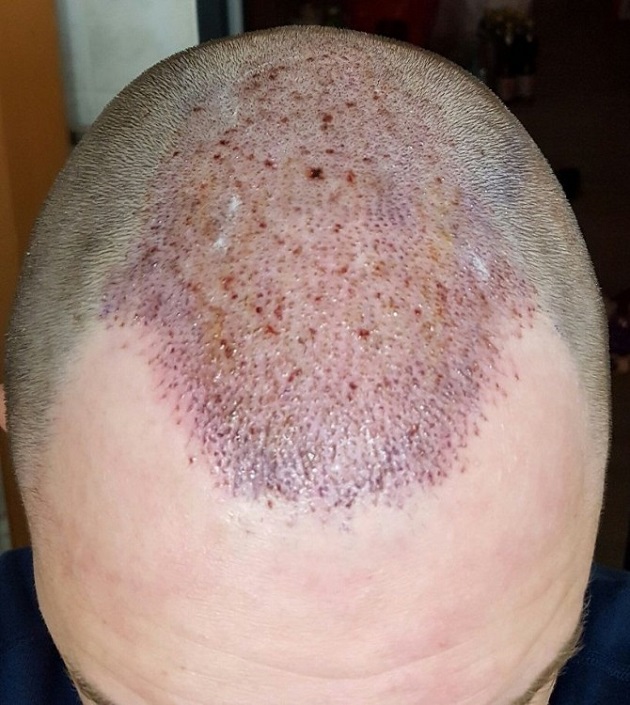 Hattingen Hair Transplant  4.jpg