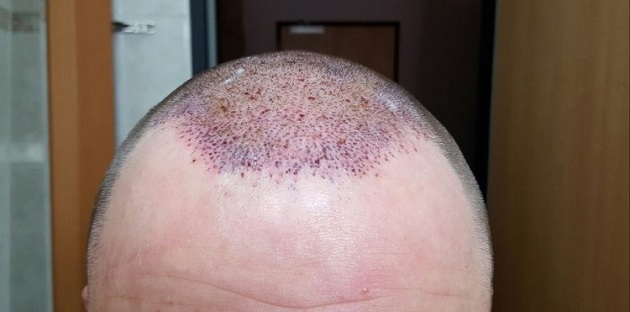 Hattingen Hair Transplant 5.jpg