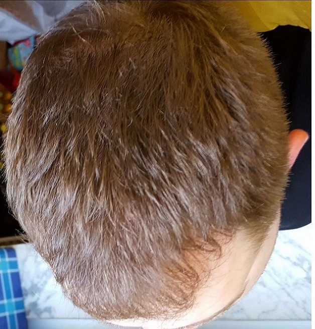 Hattingen Hair Transplant 6.jpg