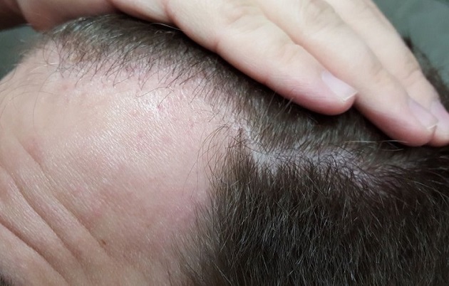 Hattingen Hair Transplant 7.jpg