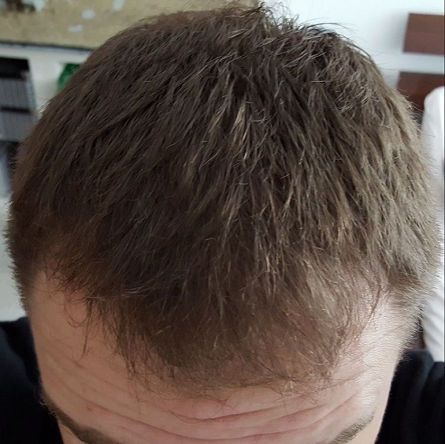 Hattingen Hair Transplant 8.jpg