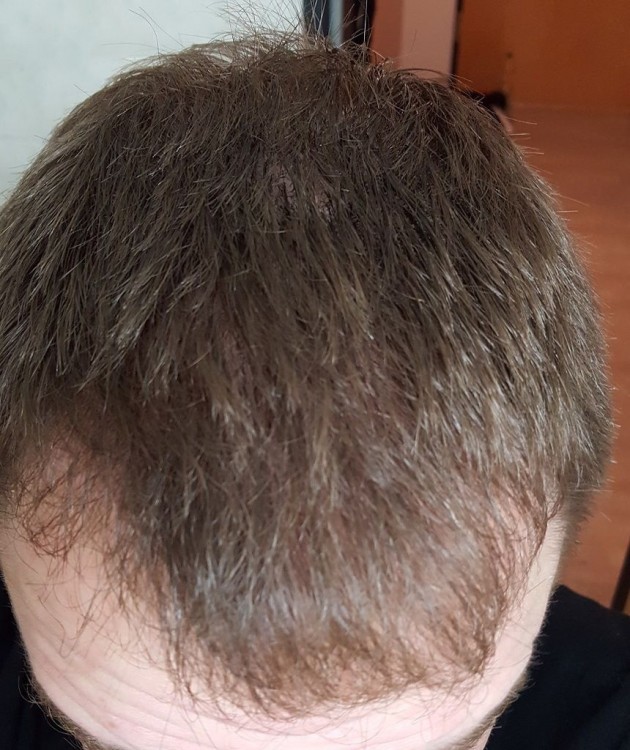 Hattingen Hair Transplant 9.jpg