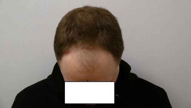 Hattingen Hair Transplant1.jpg