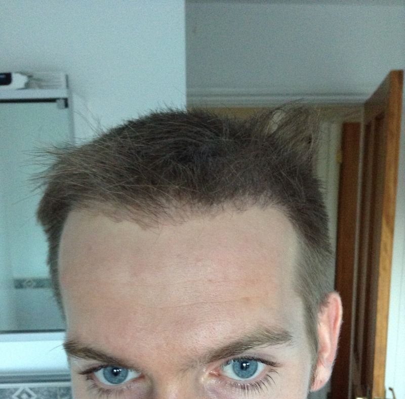HDC FUE Hairline after.jpg