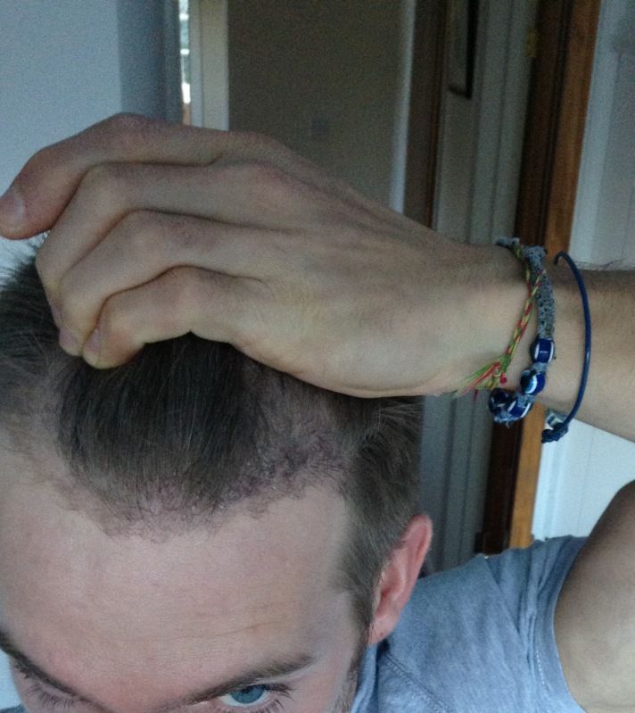 HDC FUE Hairline.jpg