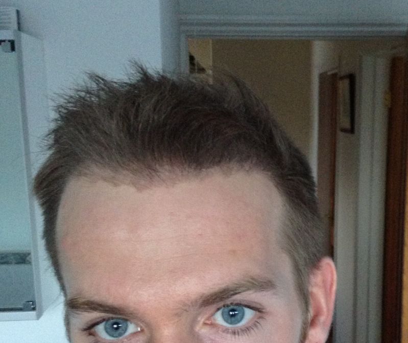 HDC FUE Hairline spiked up.jpg