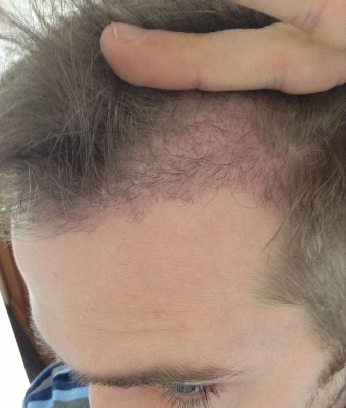 hdc hair transplant.jpg