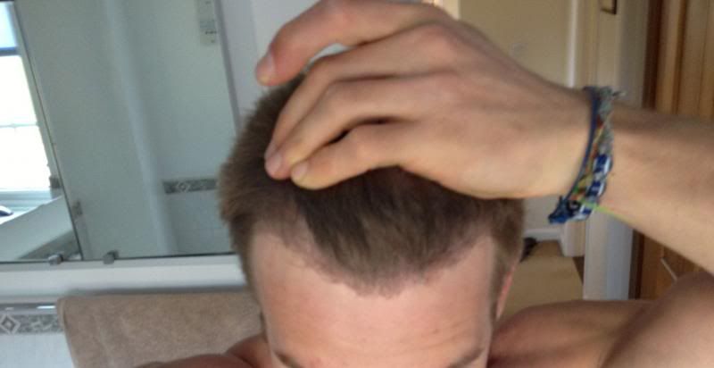 HDC Hairline 3.jpg