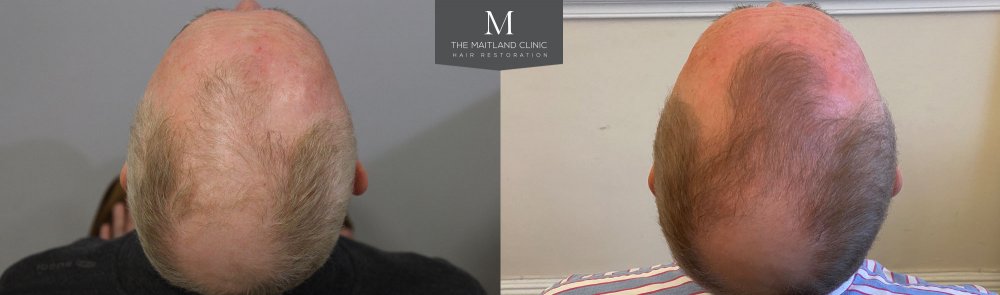 ID1624_Before_After_top.jpg