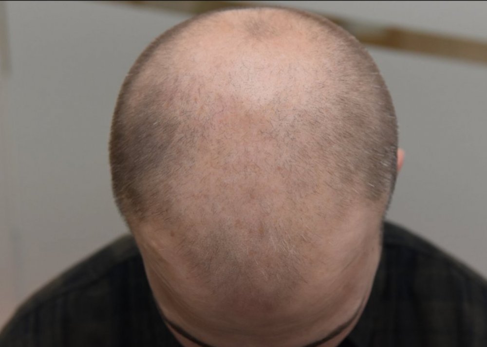 Can I expect new hair growth past 8/9 months following FUE?.. | Hair loss  Forum - Hair Transplant forums