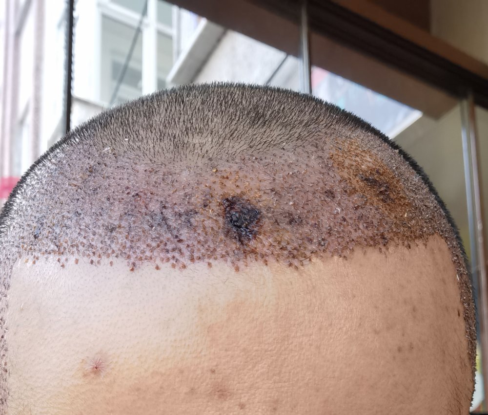 Is it necrosis? Hair loss Forum Hair Transplant forums