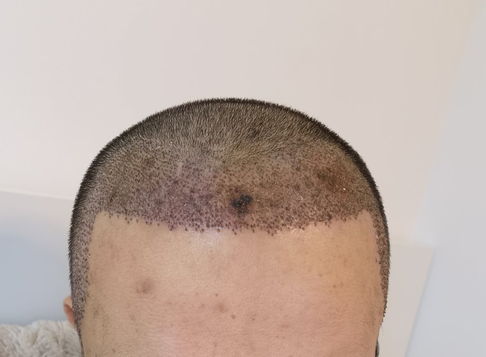 Is it necrosis? Hair loss Forum Hair Transplant forums