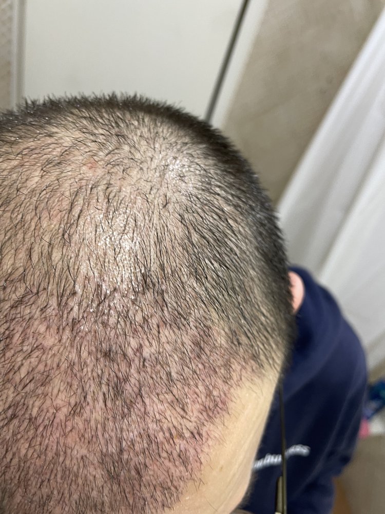 Coconut oil 2 weeks after FUE hair transplant. Damages? Hair loss Forum Hair Transplant forums