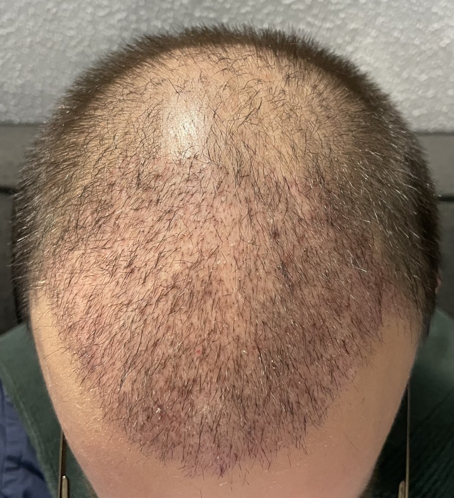 Coconut oil 2 weeks after FUE hair transplant. Damages? Hair loss Forum Hair Transplant forums