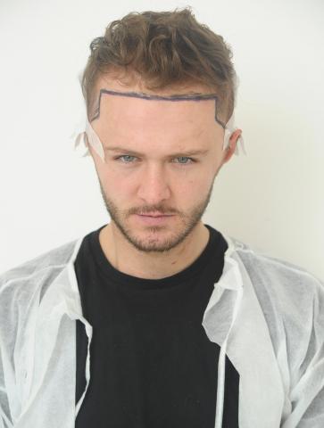 Kyle Christie Hair Transplant.jpg