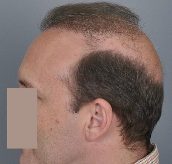 Lateral-humps hair loss.jpg