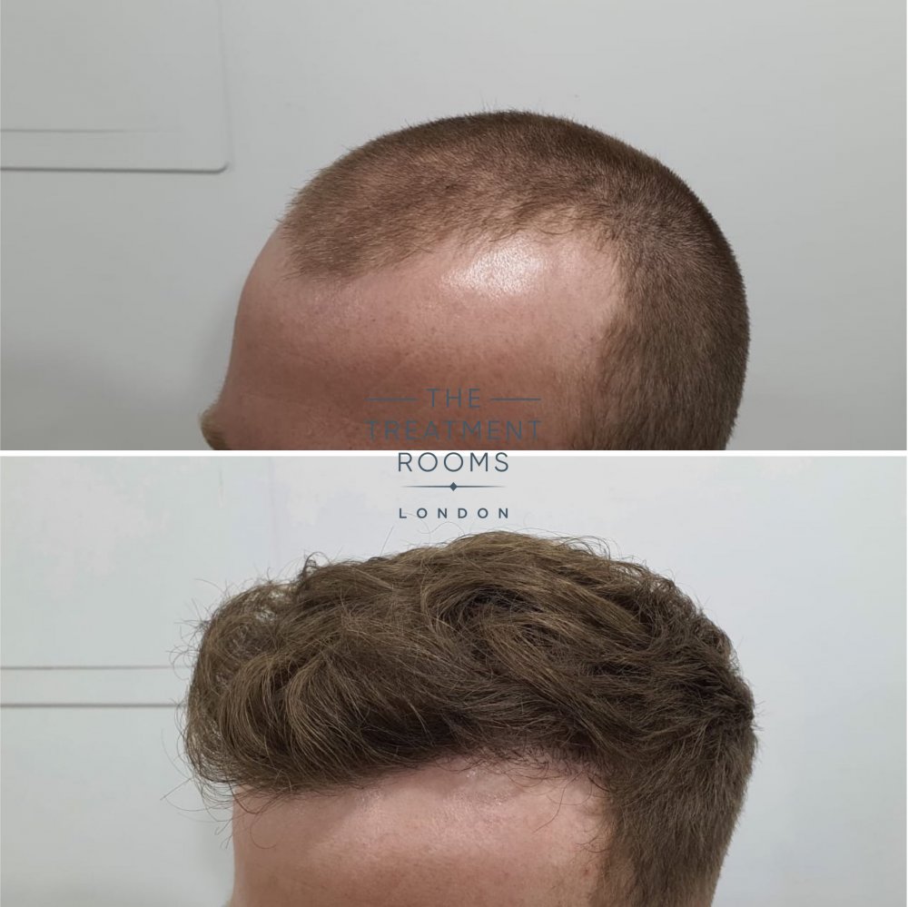 Left hairline 2.jpg