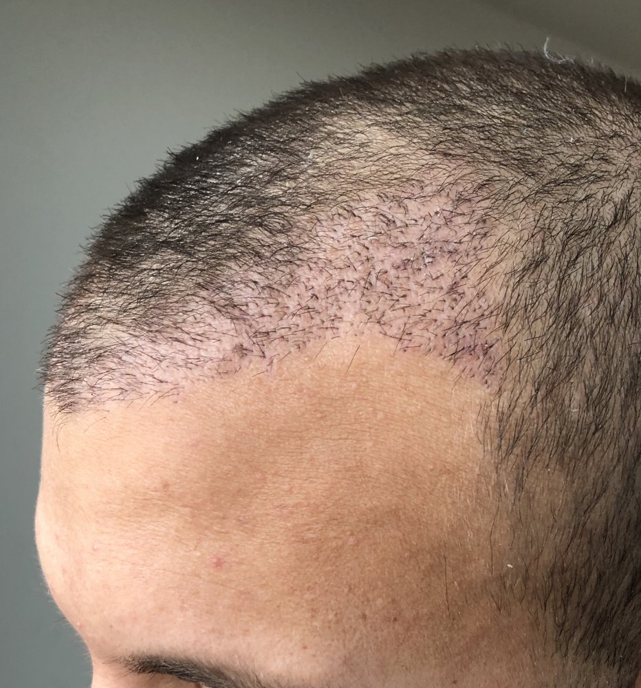 Bad Hair Transplant looking for repair advice & Dr recommendation | Hair  loss Forum - Hair Transplant forums