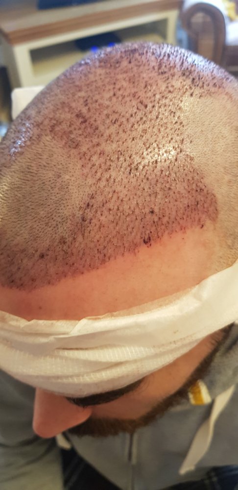 Left side 1 day post fue.jpg