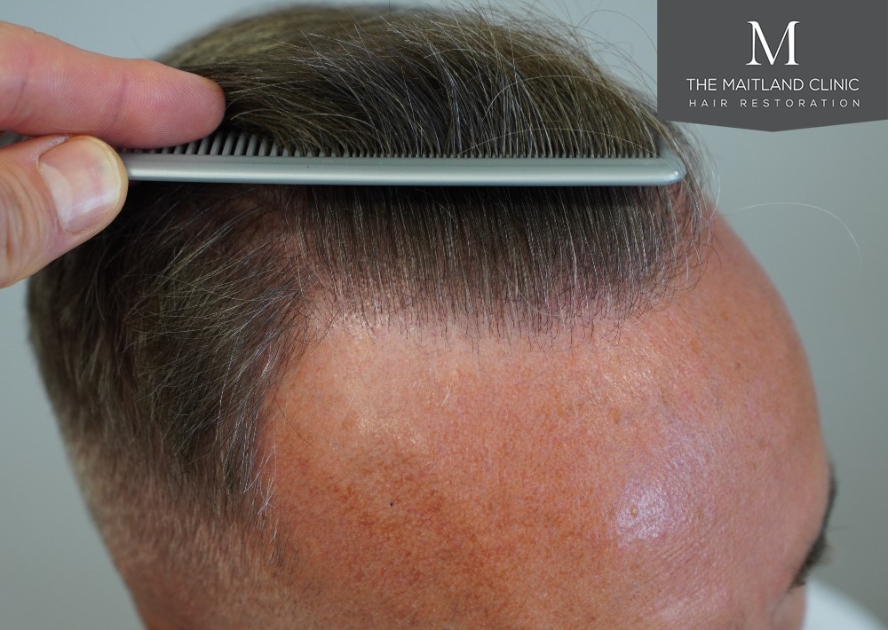 Maitland Clinic Hairline2.jpg