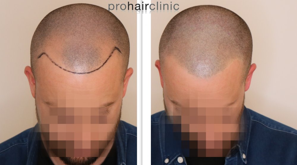 MHP frontal area.jpg