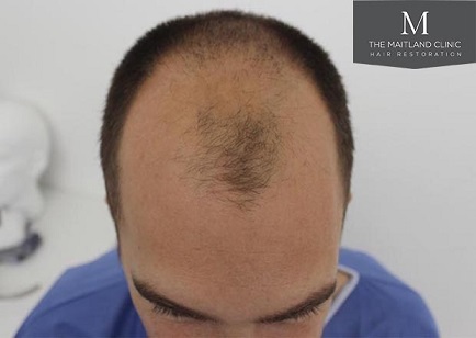 Mr Edward Maitland Ball Hair Transplant 1.jpg