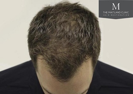 Mr Edward Maitland Ball Hair Transplant 2.jpg