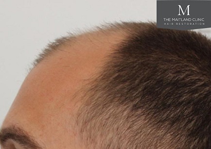 Mr Edward Maitland Ball Hair Transplant 3.jpg