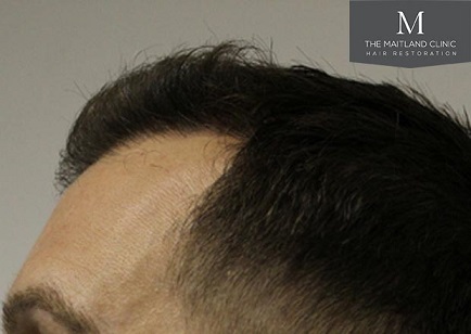 Mr Edward Maitland Ball Hair Transplant 4.jpg