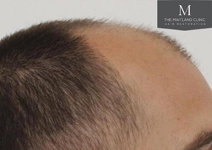 Mr Edward Maitland Ball Hair Transplant 5.jpg
