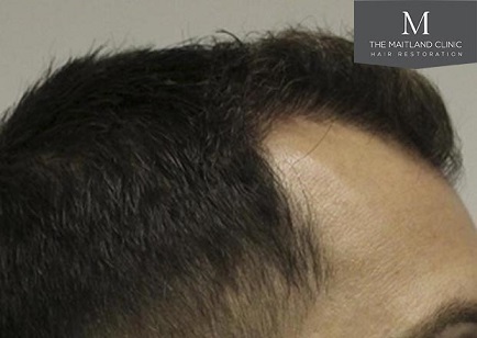 Mr Edward Maitland Ball Hair Transplant 6.jpg