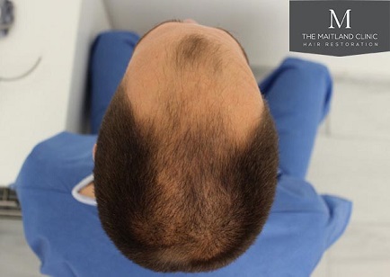 Mr Edward Maitland Ball Hair Transplant 7.jpg
