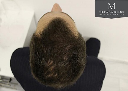 Mr Edward Maitland Ball Hair Transplant 8.jpg