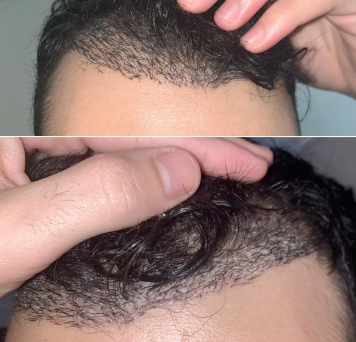 multi grafts in hairline.jpg