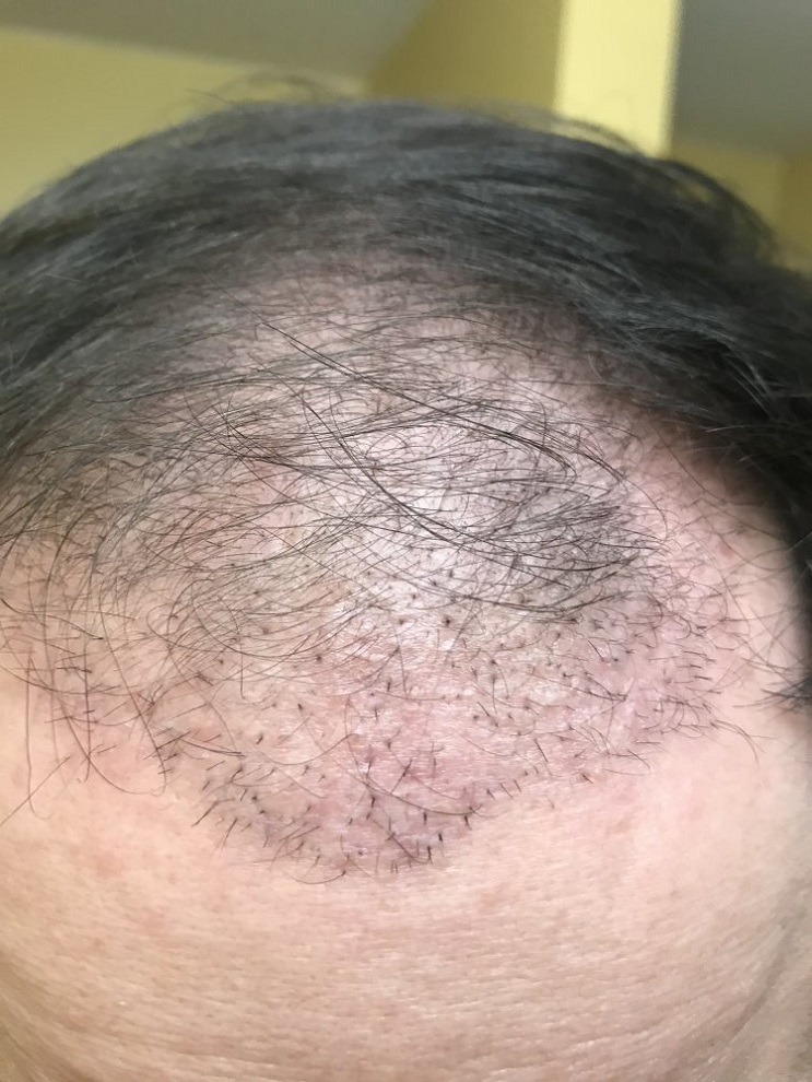 Multigrafts in hairline.jpeg