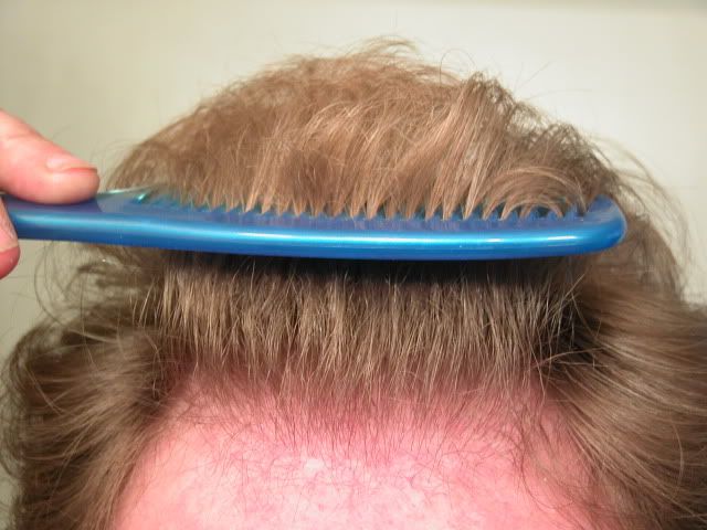 nape hair used for a hair transplant.jpg