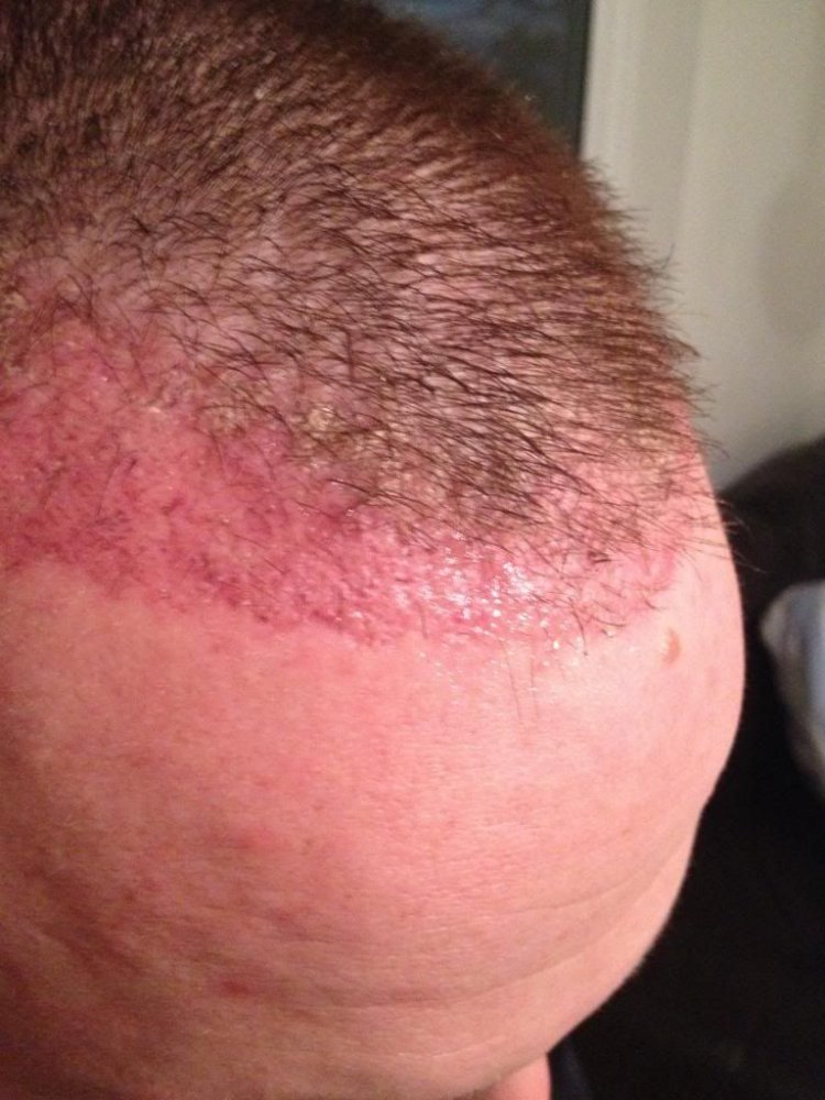 One month post op Prohair clinic Belgium.jpg