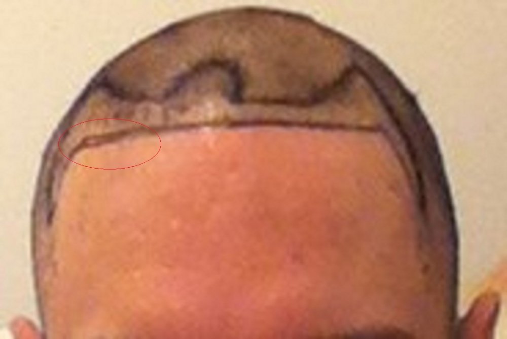 OP day hairline.jpg