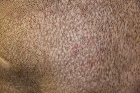 poor fue scarring.png